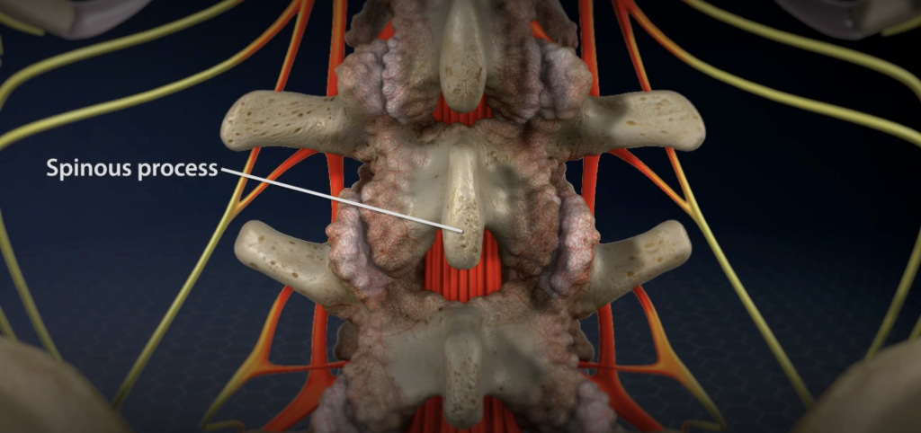 Lumbar Laminectomy - OPTIM Health System